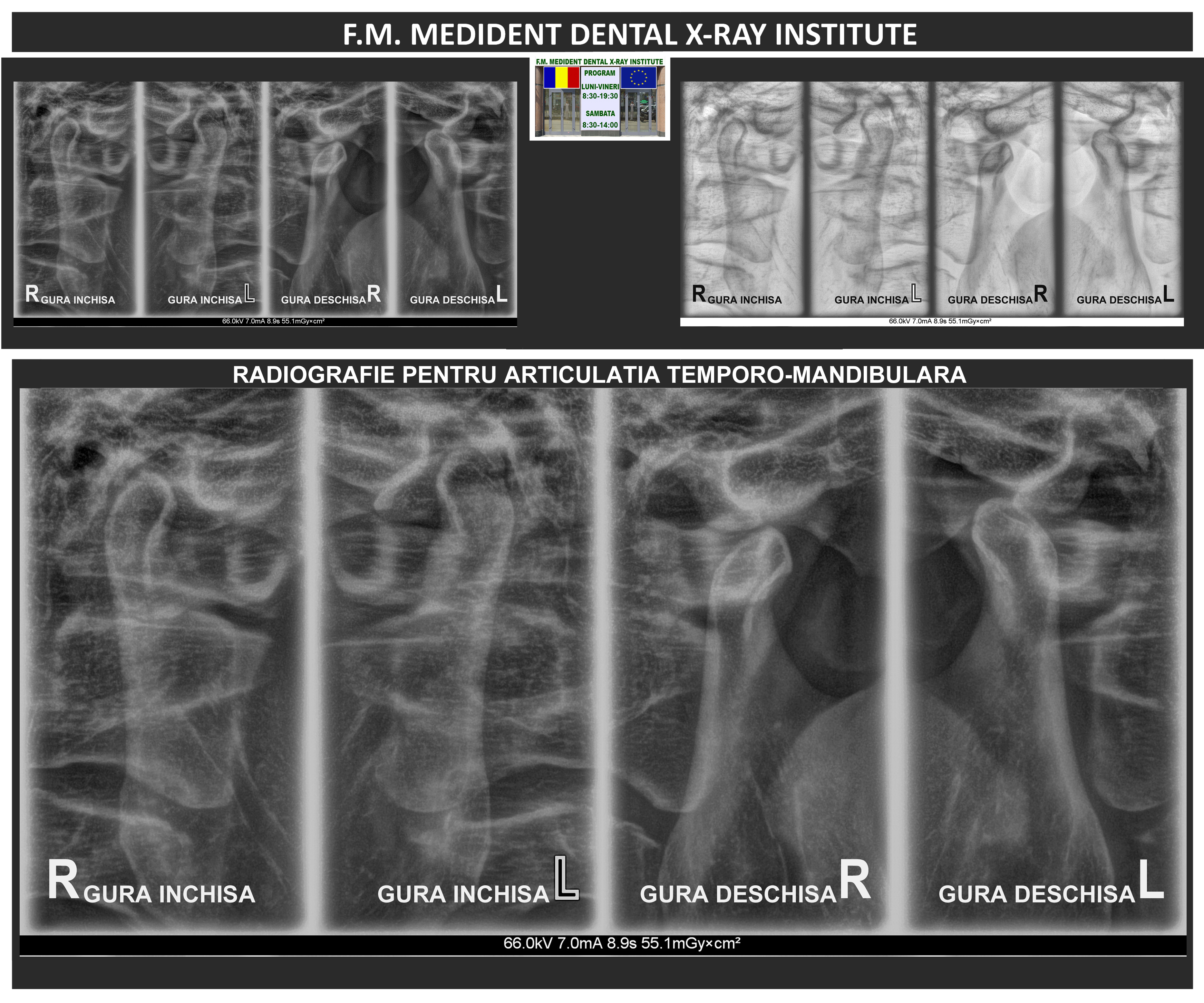 TMJ X-Ray